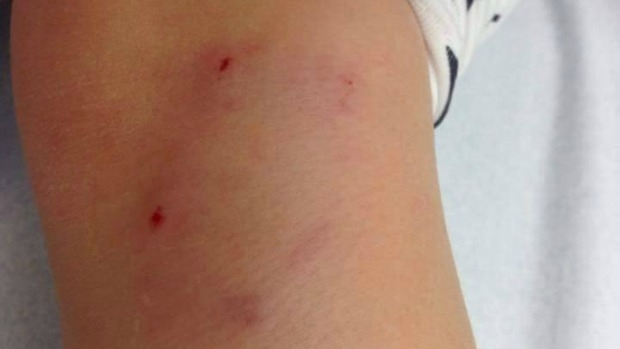 Article image for Bunnings dog policy under fire after girl bitten on leg