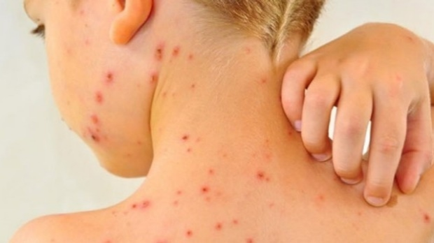 Article image for Tom Elliott clips ‘dumb’ Brunswick North West Primary over chickenpox outbreak