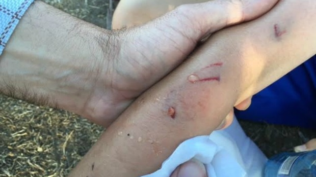 Article image for Child attacked by dog at soccer training at Yarra Bend Park