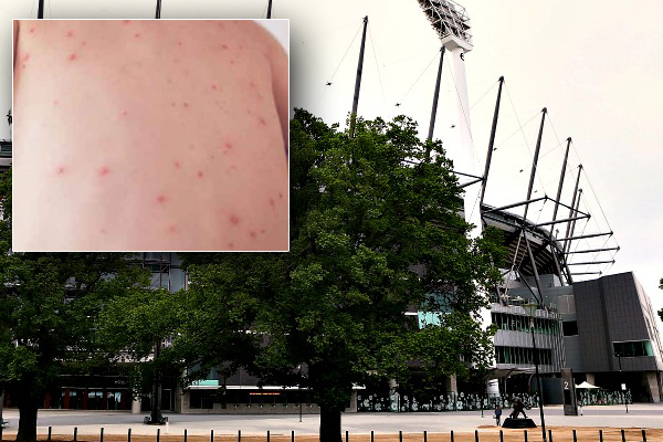 Article image for Measles alert: Patients attended MCG blockbuster, other city icons