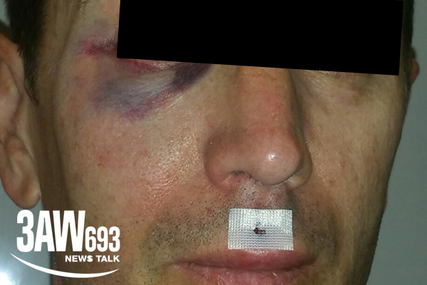Article image for Cyclist punched, set upon by fellow cyclist in vicious attack