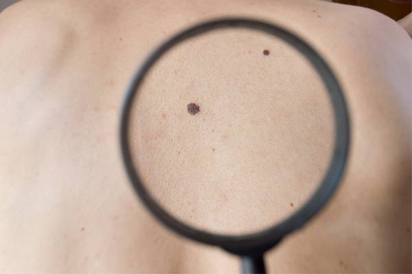 Article image for Australian researchers develop world-first test capable of detecting melanoma