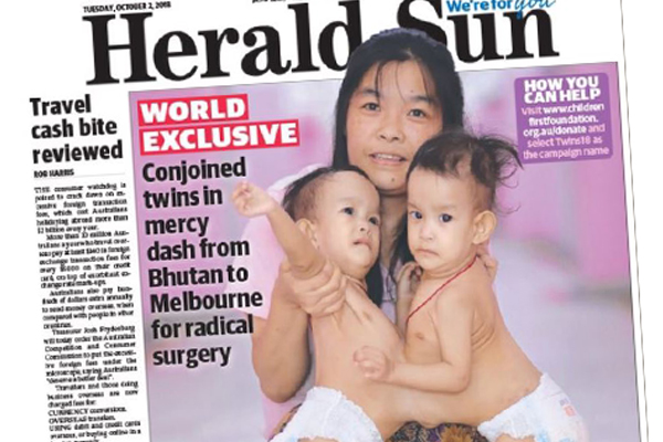 Article image for RCH to perform radical surgery to separate conjoined twins from Bhutan