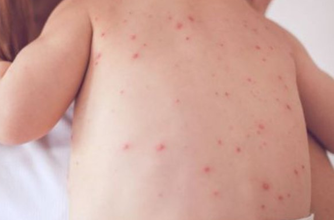 Article image for Measles alert: Six cases confirmed including one infant