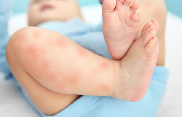 Article image for Melbourne researchers develop a cream to tackle eczema and food allergies