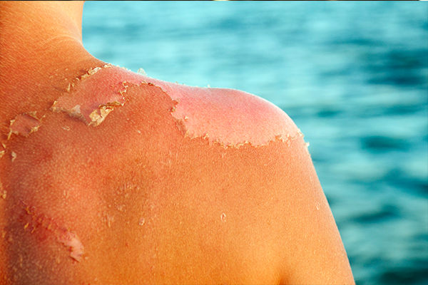 Article image for Alarming number of teenagers presenting to hospital with sunburn
