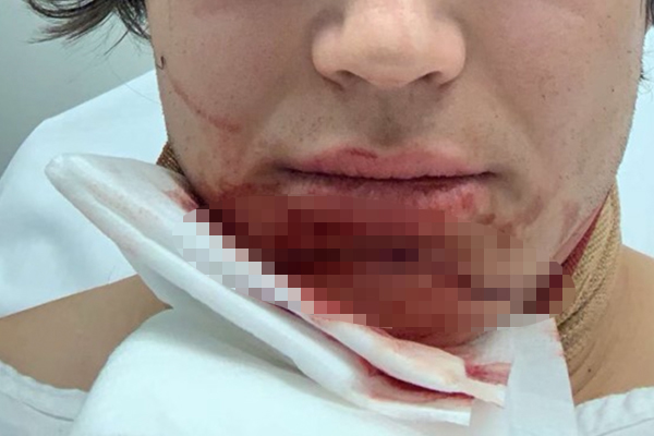 Article image for Teenager slashed in face and back in violent unprovoked St Kilda attack