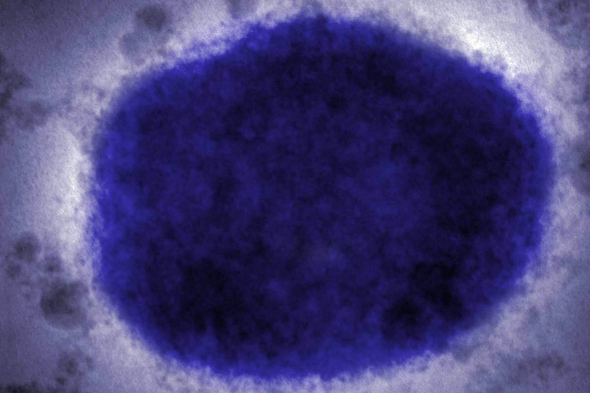 Article image for First Victorian monkeypox case detected