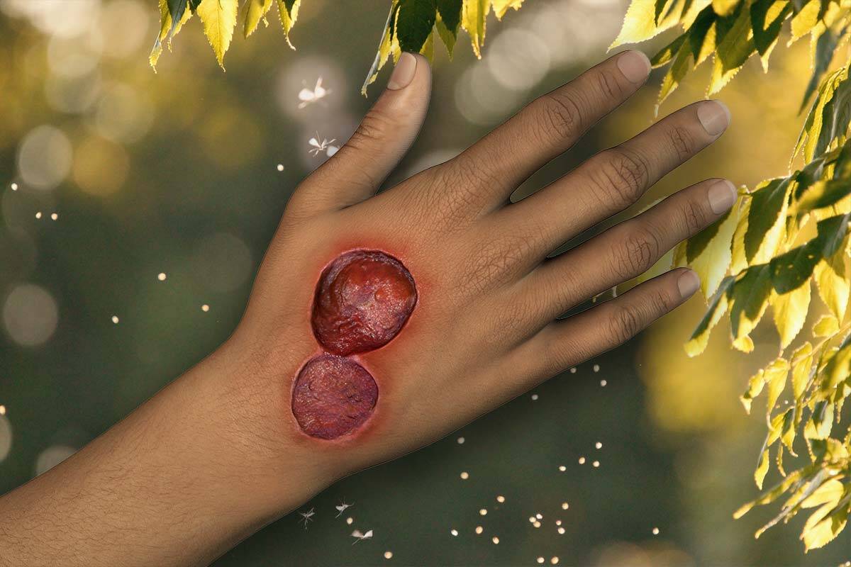 Article image for Research reveals who is at highest risk of developing flesh-eating ulcer