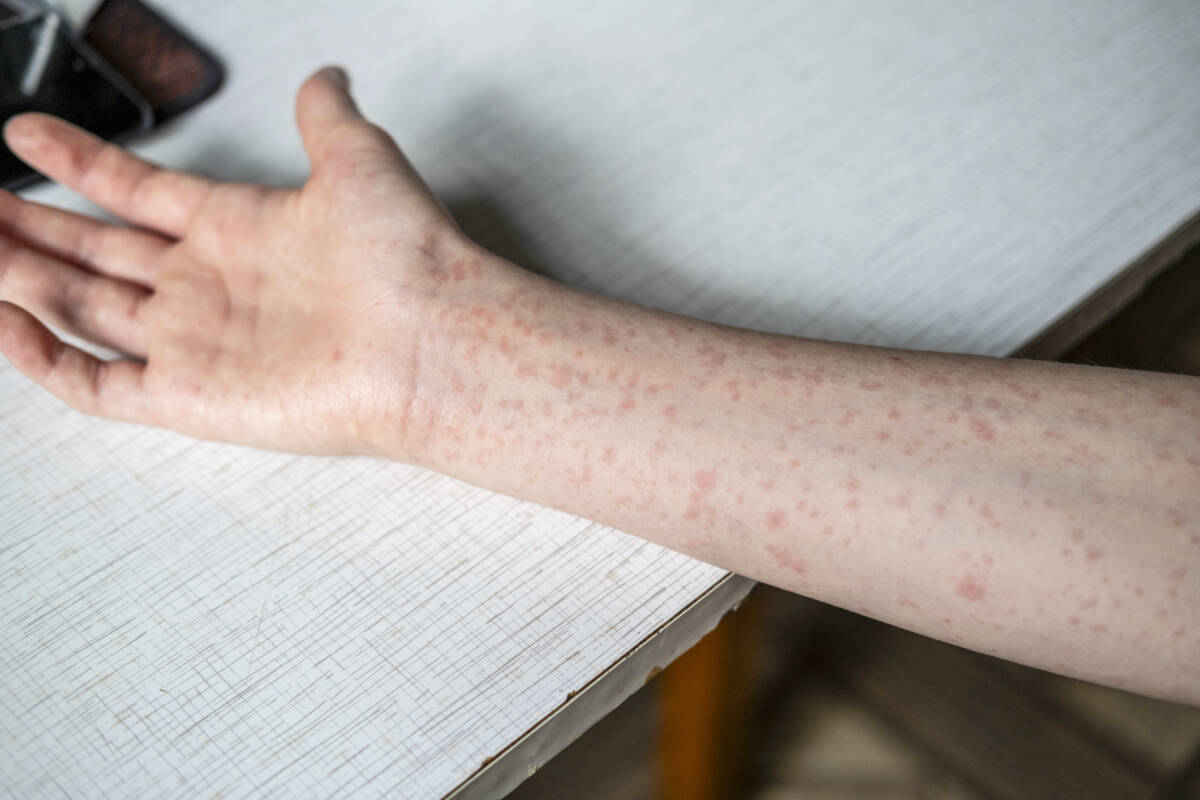 Article image for Measles breakout linked to low vaccination rates